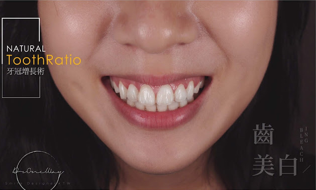 牙齒短、牙齦多，影響笑容?